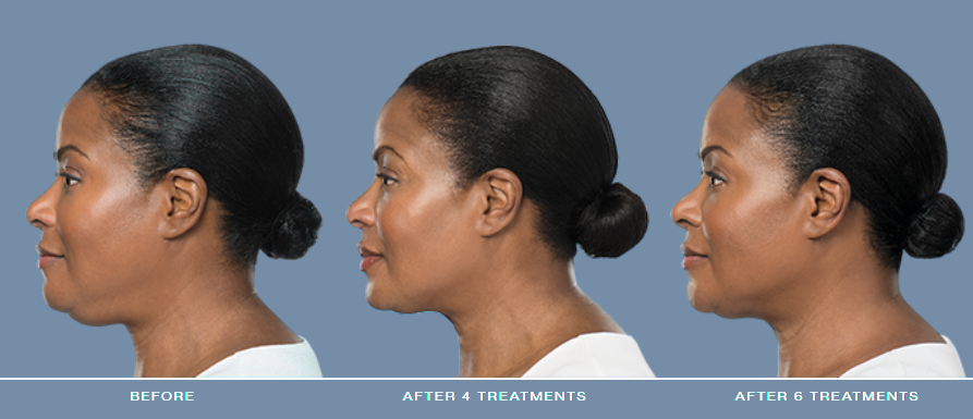 Treatment progress: before, after 4, after 6 sessions.